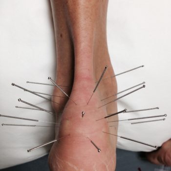 Acupuncture needles inserted around an ankle for treatment.