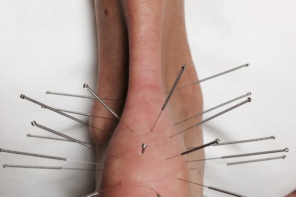 Acupuncture needles inserted around an ankle for treatment.