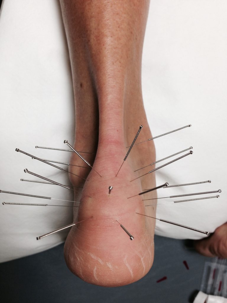 Acupuncture needles inserted around an ankle for treatment.
